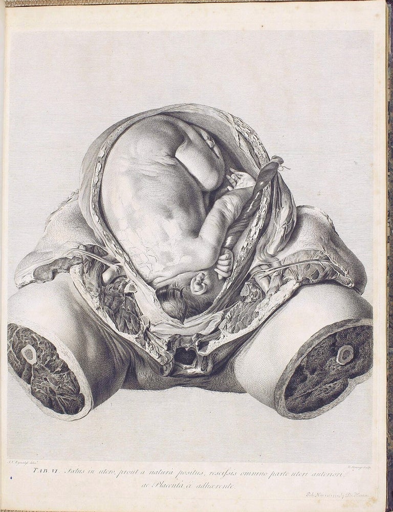 Item #001945 Anatomia uteri humani gravidi tabulis illustrata. The Anatomy of the Human Gravid Uterus exhibited in Figures. William HUNTER.