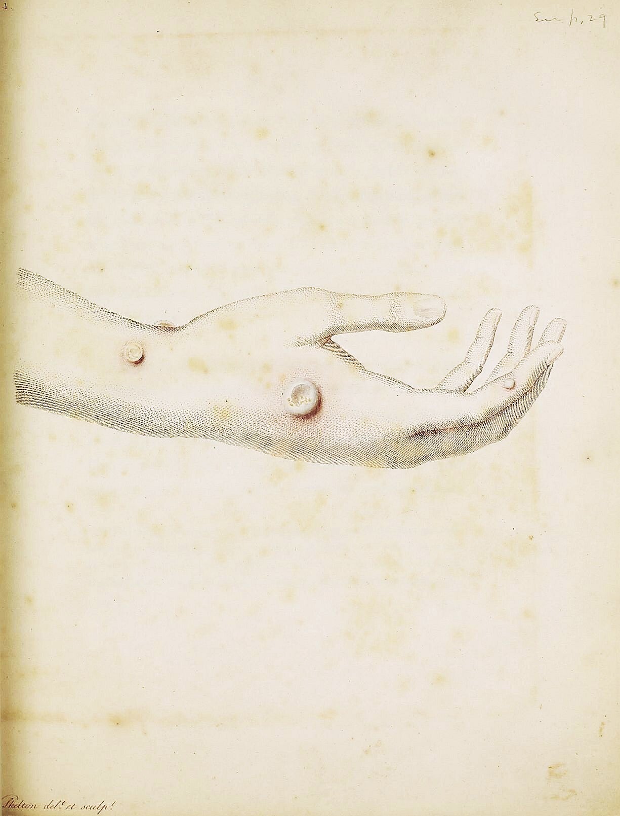 An inquiry into the causes and effects of the variolae vaccinae: a ...