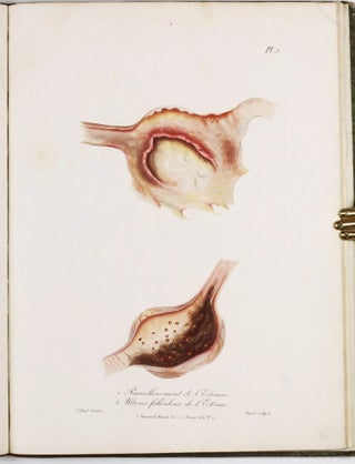 Traité des maladies des enfans nouveaux-nés et a la mamelle. . . / Atlas d'anatomie pathologique pour servir a l'histoire des maladies des enfans.
