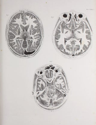 Anatome topographica sectionibus per corpus humanum congelatum triplici directione ductis illustrata.