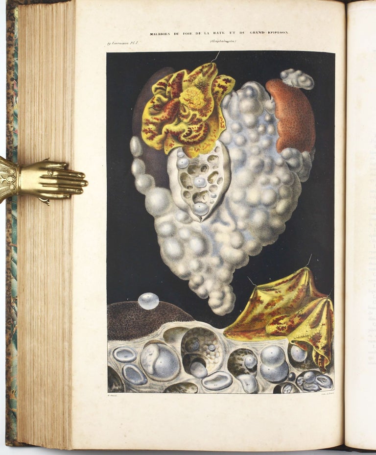 Item #003359 Anatomie pathologique du corps humain. Jean CRUVEILHIER.