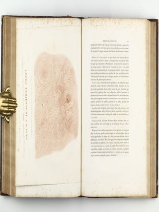 Monographie des dermatoses ou precis theorique et pratique des maladies de la peau. Seconde édition, revue, corrigée et augmentée de planches coloriées représentant environ trente espèces ou variétés de maladies.
