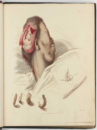 Illustrations of the Great Operations of Surgery, Trepan, Hernia, Amputation, Aneurism, and Lithotomy.