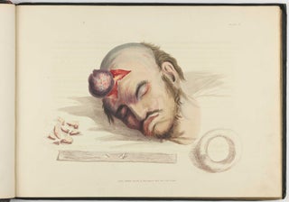 Illustrations of the Great Operations of Surgery, Trepan, Hernia, Amputation, Aneurism, and Lithotomy.