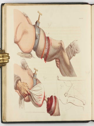 Illustrations of the Great Operations of Surgery, Trepan, Hernia, Amputation, Aneurism, and Lithotomy.
