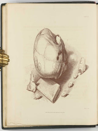 Illustrations of the Great Operations of Surgery, Trepan, Hernia, Amputation, Aneurism, and Lithotomy.