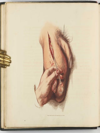 Illustrations of the Great Operations of Surgery, Trepan, Hernia, Amputation, Aneurism, and Lithotomy.