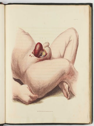 Illustrations of the Great Operations of Surgery, Trepan, Hernia, Amputation, Aneurism, and Lithotomy.