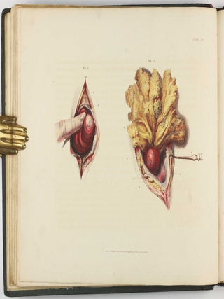 Illustrations of the Great Operations of Surgery, Trepan, Hernia, Amputation, Aneurism, and Lithotomy.