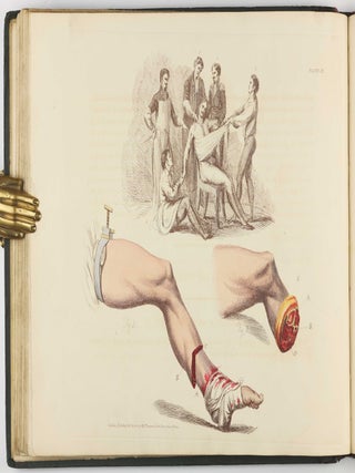 Illustrations of the Great Operations of Surgery, Trepan, Hernia, Amputation, Aneurism, and Lithotomy.