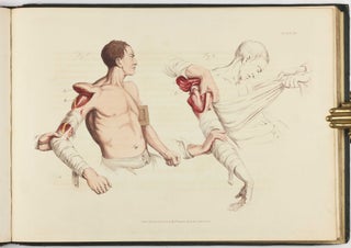 Illustrations of the Great Operations of Surgery, Trepan, Hernia, Amputation, Aneurism, and Lithotomy.