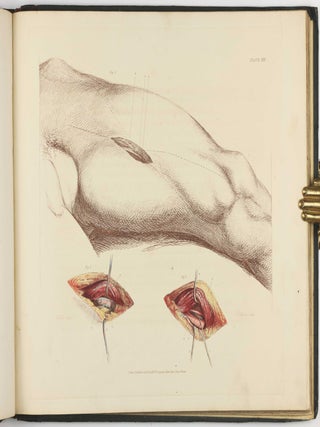 Illustrations of the Great Operations of Surgery, Trepan, Hernia, Amputation, Aneurism, and Lithotomy.