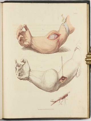 Illustrations of the Great Operations of Surgery, Trepan, Hernia, Amputation, Aneurism, and Lithotomy.
