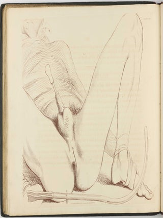 Illustrations of the Great Operations of Surgery, Trepan, Hernia, Amputation, Aneurism, and Lithotomy.