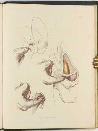Illustrations of the Great Operations of Surgery, Trepan, Hernia, Amputation, Aneurism, and Lithotomy.