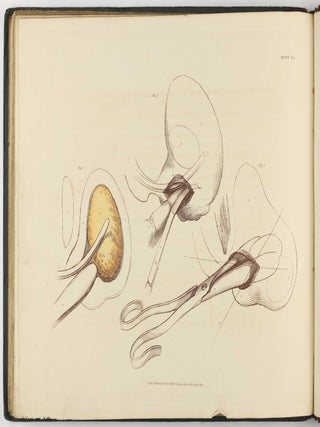 Illustrations of the Great Operations of Surgery, Trepan, Hernia, Amputation, Aneurism, and Lithotomy.