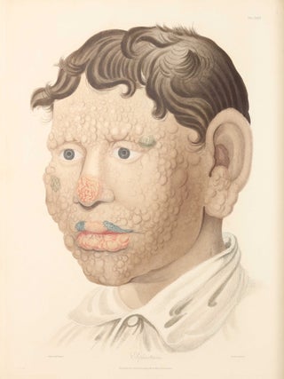 Delineations of Cutaneous Diseases, Exhibiting the Characteristic Appearances of the Principal Genera and Species Comprised in the Classification of the Late Doctor Willan, and Completing a Series of Engravings Begun by that Author, new edition.