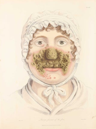 Delineations of Cutaneous Diseases, Exhibiting the Characteristic Appearances of the Principal Genera and Species Comprised in the Classification of the Late Doctor Willan, and Completing a Series of Engravings Begun by that Author, new edition.