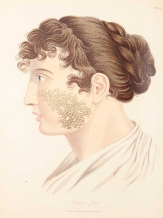 Delineations of Cutaneous Diseases, Exhibiting the Characteristic Appearances of the Principal Genera and Species Comprised in the Classification of the Late Doctor Willan, and Completing a Series of Engravings Begun by that Author, new edition.