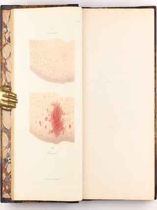 Delineations of Cutaneous Diseases, Exhibiting the Characteristic Appearances of the Principal Genera and Species Comprised in the Classification of the Late Doctor Willan, and Completing a Series of Engravings Begun by that Author, new edition.