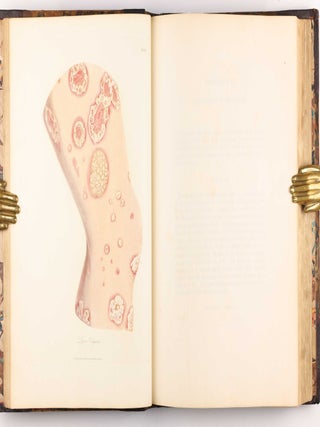 Delineations of Cutaneous Diseases, Exhibiting the Characteristic Appearances of the Principal Genera and Species Comprised in the Classification of the Late Doctor Willan, and Completing a Series of Engravings Begun by that Author, new edition.