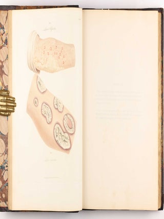 Delineations of Cutaneous Diseases, Exhibiting the Characteristic Appearances of the Principal Genera and Species Comprised in the Classification of the Late Doctor Willan, and Completing a Series of Engravings Begun by that Author, new edition.