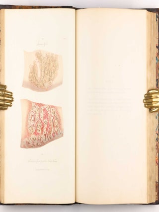 Delineations of Cutaneous Diseases, Exhibiting the Characteristic Appearances of the Principal Genera and Species Comprised in the Classification of the Late Doctor Willan, and Completing a Series of Engravings Begun by that Author, new edition.