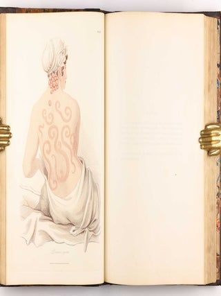 Delineations of Cutaneous Diseases, Exhibiting the Characteristic Appearances of the Principal Genera and Species Comprised in the Classification of the Late Doctor Willan, and Completing a Series of Engravings Begun by that Author, new edition.