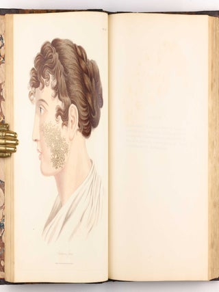 Delineations of Cutaneous Diseases, Exhibiting the Characteristic Appearances of the Principal Genera and Species Comprised in the Classification of the Late Doctor Willan, and Completing a Series of Engravings Begun by that Author, new edition.