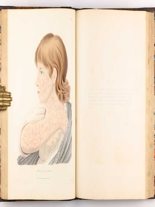Delineations of Cutaneous Diseases, Exhibiting the Characteristic Appearances of the Principal Genera and Species Comprised in the Classification of the Late Doctor Willan, and Completing a Series of Engravings Begun by that Author, new edition.