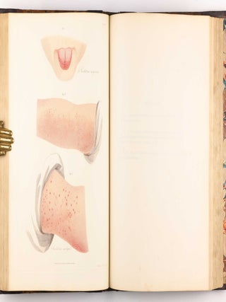 Delineations of Cutaneous Diseases, Exhibiting the Characteristic Appearances of the Principal Genera and Species Comprised in the Classification of the Late Doctor Willan, and Completing a Series of Engravings Begun by that Author, new edition.