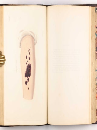 Delineations of Cutaneous Diseases, Exhibiting the Characteristic Appearances of the Principal Genera and Species Comprised in the Classification of the Late Doctor Willan, and Completing a Series of Engravings Begun by that Author, new edition.