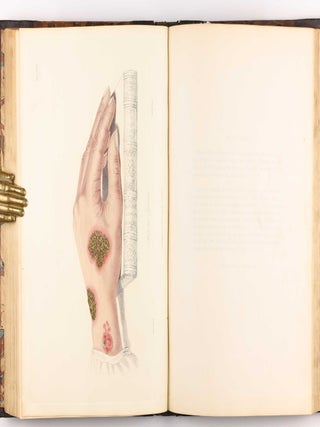 Delineations of Cutaneous Diseases, Exhibiting the Characteristic Appearances of the Principal Genera and Species Comprised in the Classification of the Late Doctor Willan, and Completing a Series of Engravings Begun by that Author, new edition.