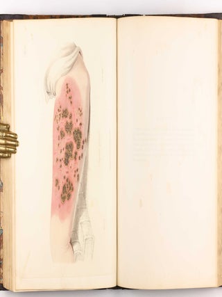 Delineations of Cutaneous Diseases, Exhibiting the Characteristic Appearances of the Principal Genera and Species Comprised in the Classification of the Late Doctor Willan, and Completing a Series of Engravings Begun by that Author, new edition.