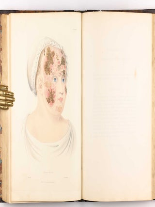 Delineations of Cutaneous Diseases, Exhibiting the Characteristic Appearances of the Principal Genera and Species Comprised in the Classification of the Late Doctor Willan, and Completing a Series of Engravings Begun by that Author, new edition.