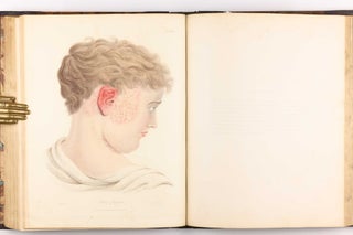 Delineations of Cutaneous Diseases, Exhibiting the Characteristic Appearances of the Principal Genera and Species Comprised in the Classification of the Late Doctor Willan, and Completing a Series of Engravings Begun by that Author, new edition.