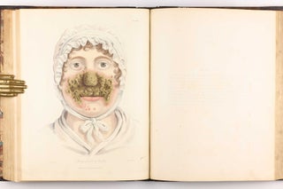 Delineations of Cutaneous Diseases, Exhibiting the Characteristic Appearances of the Principal Genera and Species Comprised in the Classification of the Late Doctor Willan, and Completing a Series of Engravings Begun by that Author, new edition.