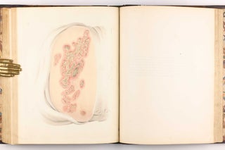 Delineations of Cutaneous Diseases, Exhibiting the Characteristic Appearances of the Principal Genera and Species Comprised in the Classification of the Late Doctor Willan, and Completing a Series of Engravings Begun by that Author, new edition.