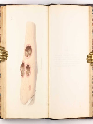 Delineations of Cutaneous Diseases, Exhibiting the Characteristic Appearances of the Principal Genera and Species Comprised in the Classification of the Late Doctor Willan, and Completing a Series of Engravings Begun by that Author, new edition.
