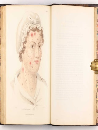 Delineations of Cutaneous Diseases, Exhibiting the Characteristic Appearances of the Principal Genera and Species Comprised in the Classification of the Late Doctor Willan, and Completing a Series of Engravings Begun by that Author, new edition.