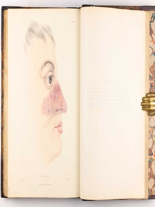 Delineations of Cutaneous Diseases, Exhibiting the Characteristic Appearances of the Principal Genera and Species Comprised in the Classification of the Late Doctor Willan, and Completing a Series of Engravings Begun by that Author, new edition.