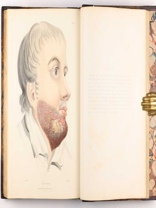 Delineations of Cutaneous Diseases, Exhibiting the Characteristic Appearances of the Principal Genera and Species Comprised in the Classification of the Late Doctor Willan, and Completing a Series of Engravings Begun by that Author, new edition.