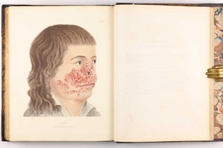 Delineations of Cutaneous Diseases, Exhibiting the Characteristic Appearances of the Principal Genera and Species Comprised in the Classification of the Late Doctor Willan, and Completing a Series of Engravings Begun by that Author, new edition.