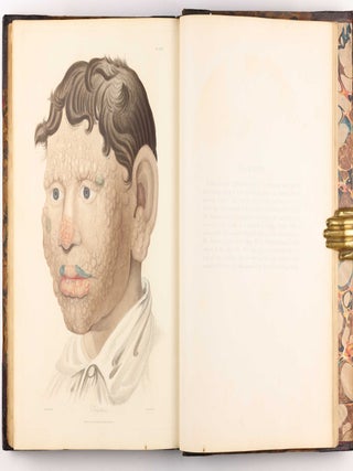 Delineations of Cutaneous Diseases, Exhibiting the Characteristic Appearances of the Principal Genera and Species Comprised in the Classification of the Late Doctor Willan, and Completing a Series of Engravings Begun by that Author, new edition.