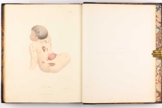 Delineations of Cutaneous Diseases, Exhibiting the Characteristic Appearances of the Principal Genera and Species Comprised in the Classification of the Late Doctor Willan, and Completing a Series of Engravings Begun by that Author, new edition.