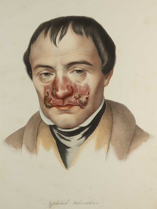 Traité des syphilides ou maladies vénériennes de la peau, precedee de considerations sur la syphilis, son origine, sa nature etc.