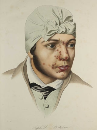 Traité des syphilides ou maladies vénériennes de la peau, precedee de considerations sur la syphilis, son origine, sa nature etc.