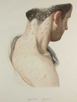 Traité des syphilides ou maladies vénériennes de la peau, precedee de considerations sur la syphilis, son origine, sa nature etc.