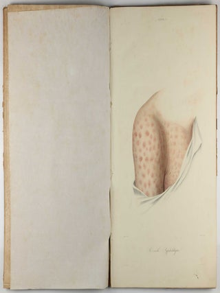 Traité des syphilides ou maladies vénériennes de la peau, precedee de considerations sur la syphilis, son origine, sa nature etc.