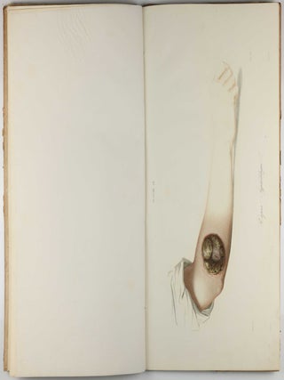 Traité des syphilides ou maladies vénériennes de la peau, precedee de considerations sur la syphilis, son origine, sa nature etc.